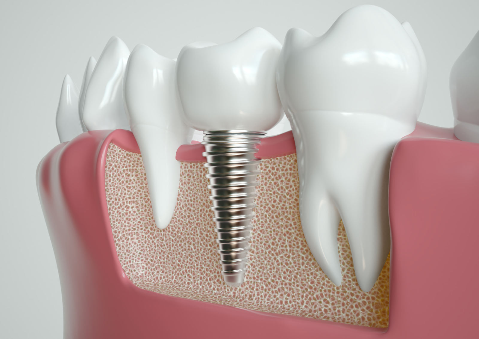 Implantologia dentale di eccellenza a Milano e Bergamo.