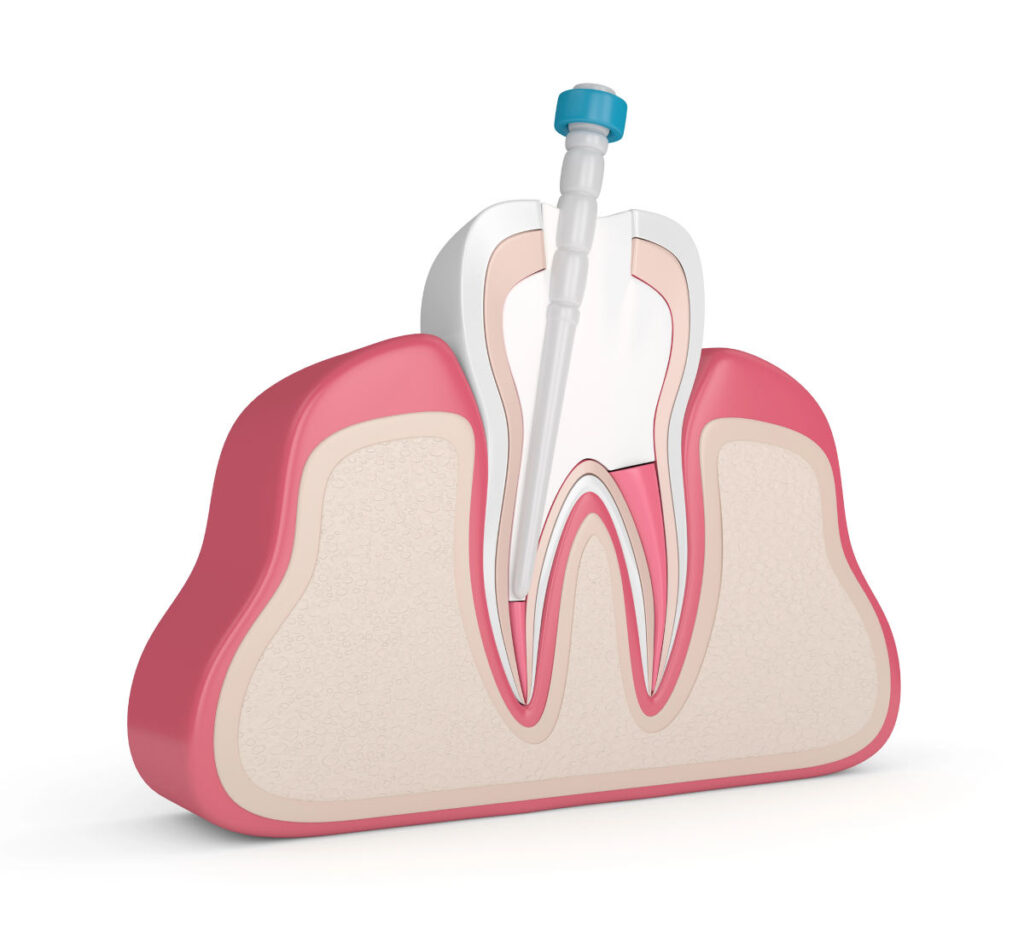 endodonzia