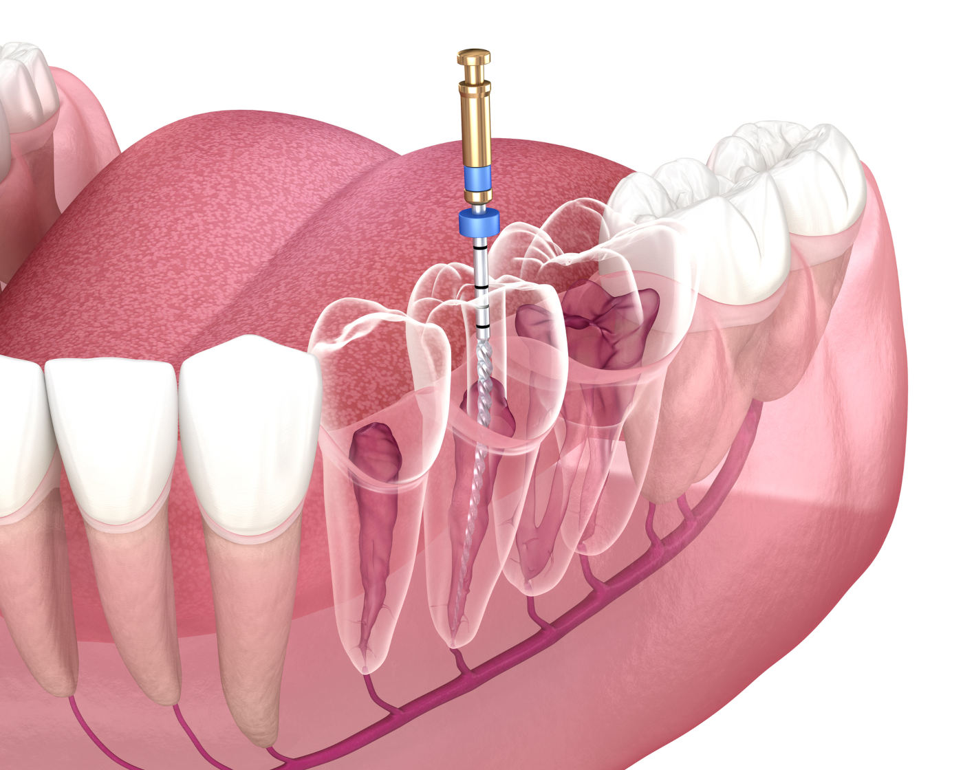 trattamenti di endodonzia milano bergamo