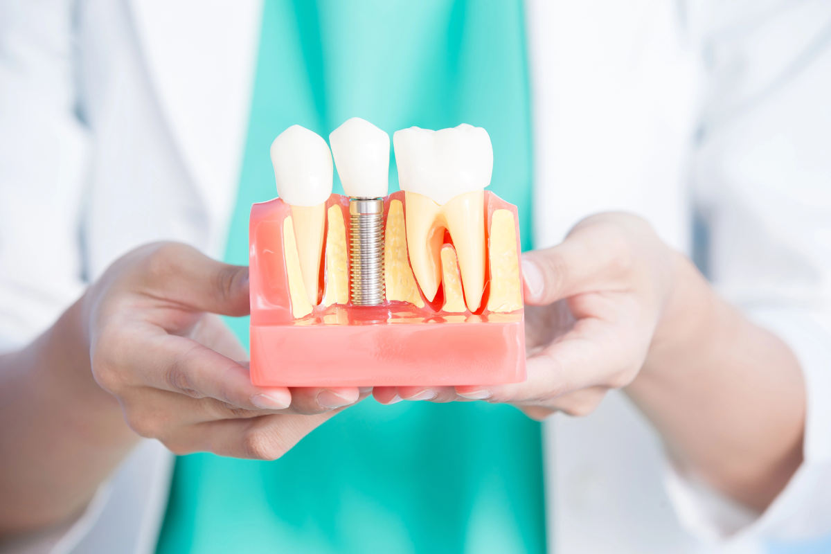 implantologia dentale