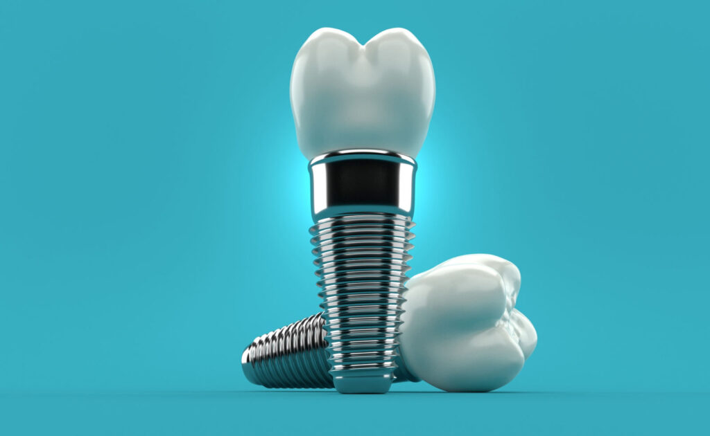 implantologia dentale milano bergamo